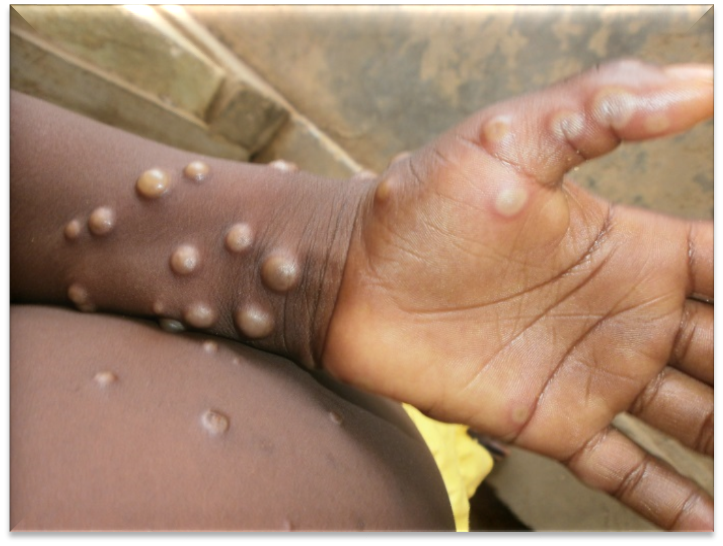 HONG KONG’S LATEST MONKEYPOX CASE VISITED MACAU FROM 4-5 APRIL HONG KONG’S LATEST MONKEYPOX CASE VISITED MACAU FROM 4-5 APRIL
